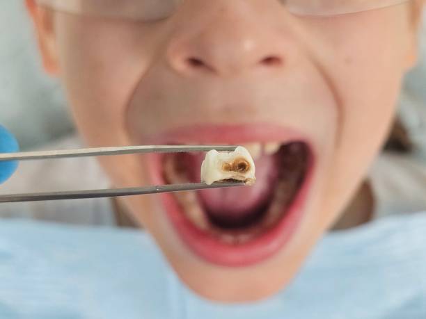 Best Emergency Tooth Extraction in Sunrise Beach Village, TX